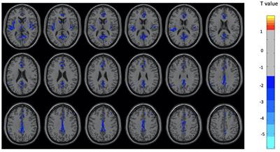 Neuroimaging evaluation of the long term impact of a novel paired meditation practice on brain function